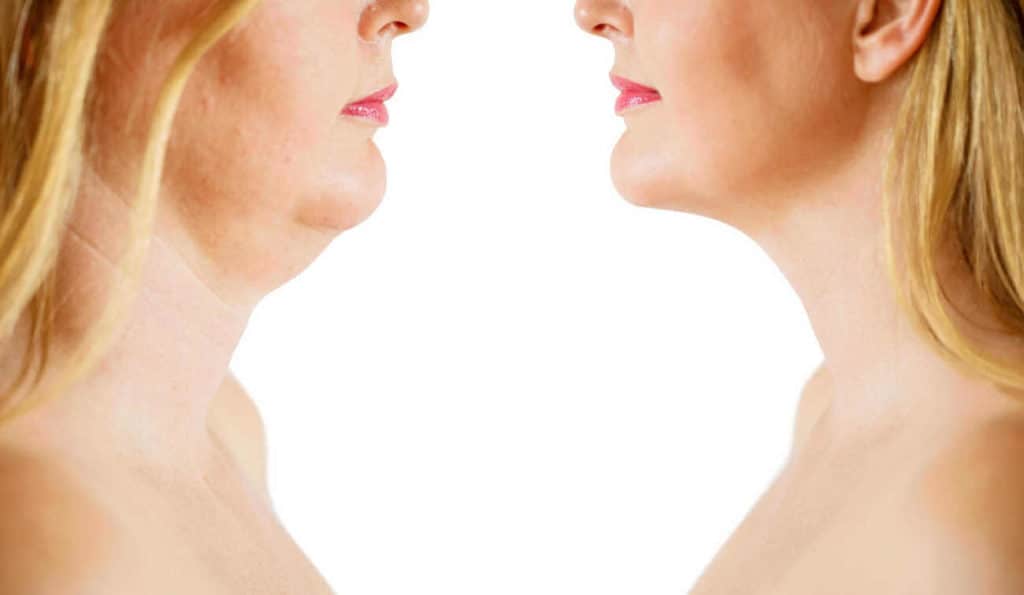 Double Chin treatment Port Glasgow before and after results