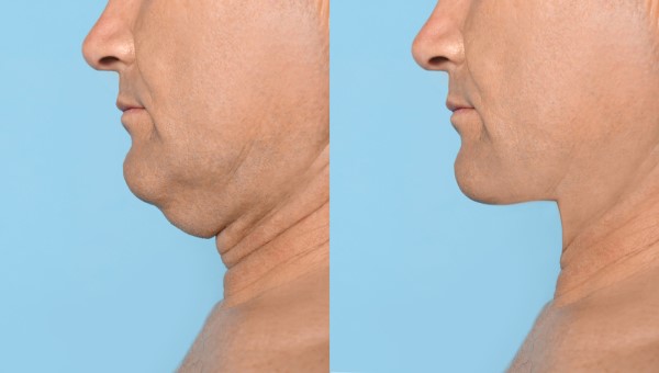 Which Non-Surgical Treatments Work Best for Jowls and Loose Skin Port Glasgow?