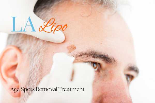 What Are the Most Effective Treatments for Age Spots Port Glasgow?