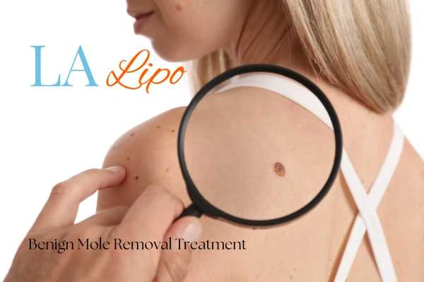 Woman having her inspection of blemish before mole removal Port Glasgow