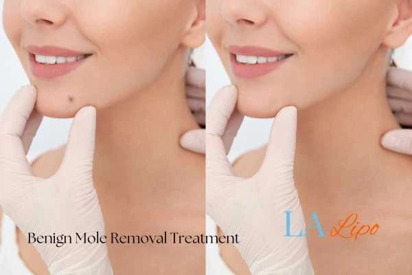 Before and after mole removal Port Glasgow treatment
