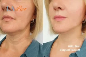 hi-fu for wrinkles Port Glasgow before and after results