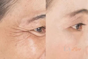 Before and after results of woman - HI-fu wrinkles reduction treatment Port Glasgow
