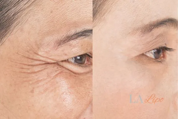 Before and after results of woman - HI-fu wrinkles reduction treatment Port Glasgow