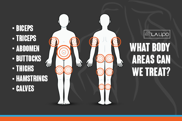 Graphic to show areas you can have LA-EMS Body Sculpting Port Glasgow treatment.