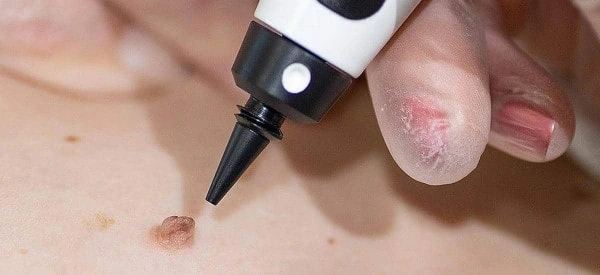 skin tag removal using cryopen Port Glasgow