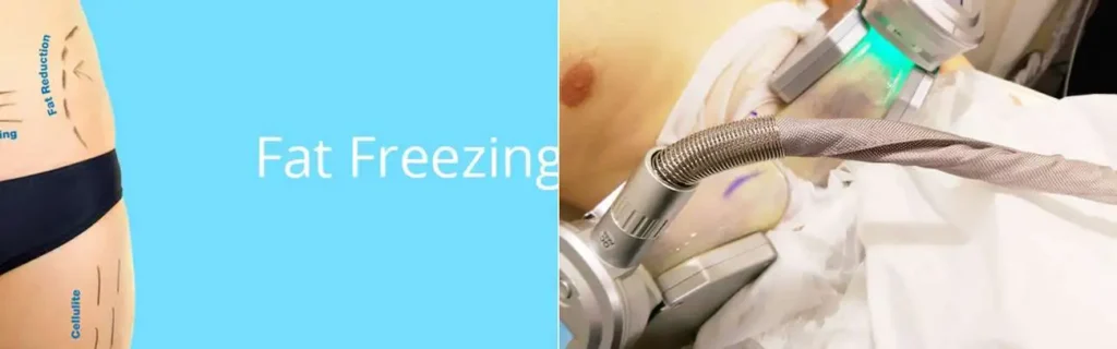multi areas of a persons body having coolsculpting Port Glasgow treatment