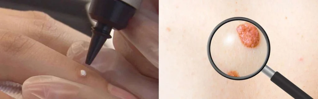 CryoPen practitioner Port Glasgow assessing a benign mole before treatment