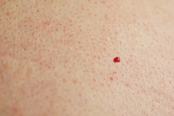 close up of a cherry angioma Port Glasgow