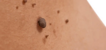 image of a skin tag Port Glasgow