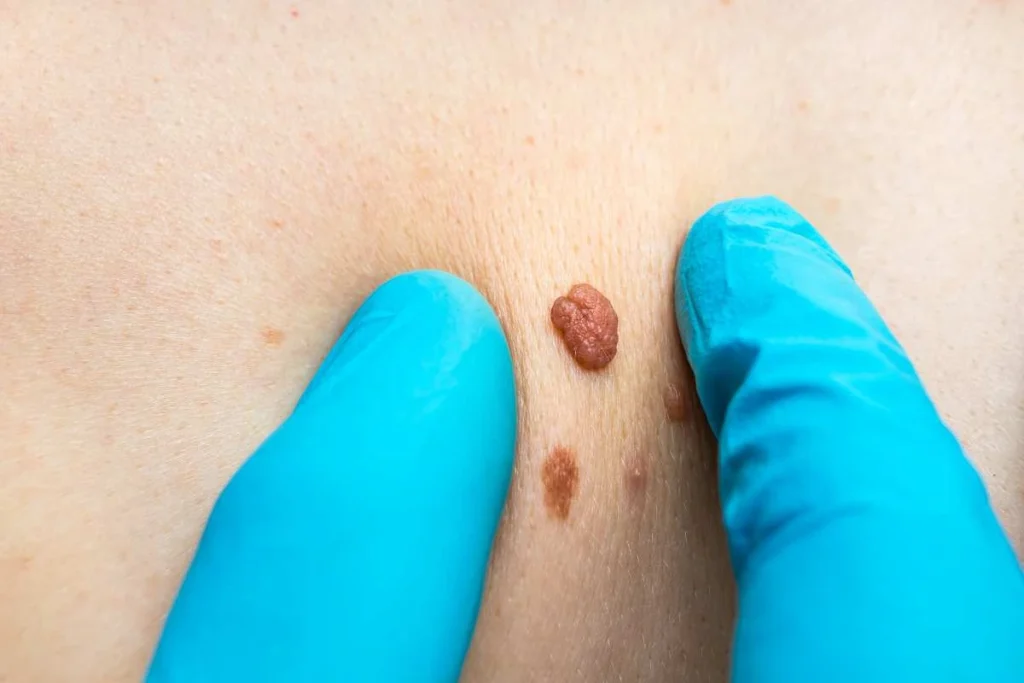 Consultant examining a skin tag Port Glasgow