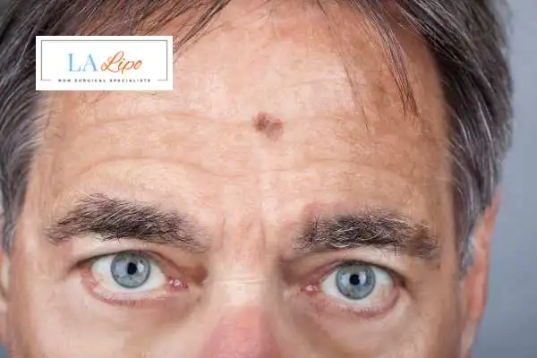 Solar Lentigo Removal Port Glasgow image of man with mark on his forehead