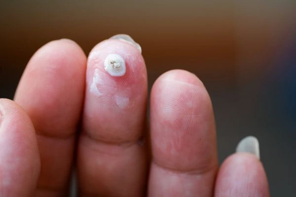 wart on person finger - cryotherapy to treat from LA LIPO Port Glasgow