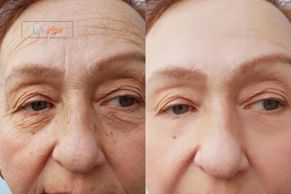 The powerful benefits of Morpheus8 Treatment Port Glasgow - Call Our team today!