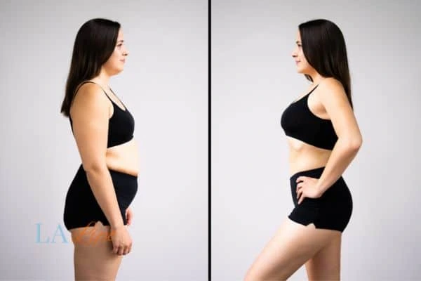 Picture of womans before and after using LA-EMS body sculpting to improve her core strength Port Glasgow