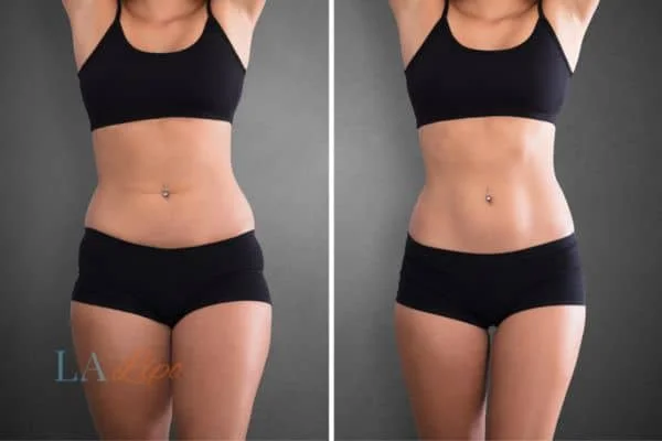 before and after results of non-surgical treatment to help a woman's body image and mental health Port Glasgow