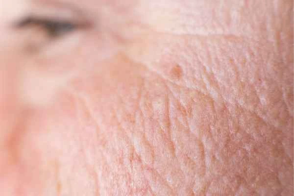 close up picture of a woman's face showing an age spot Port Glasgow