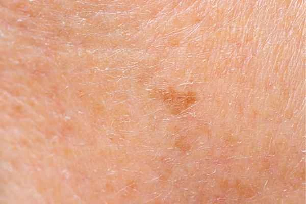 close up picture of age spots Port Glasgow