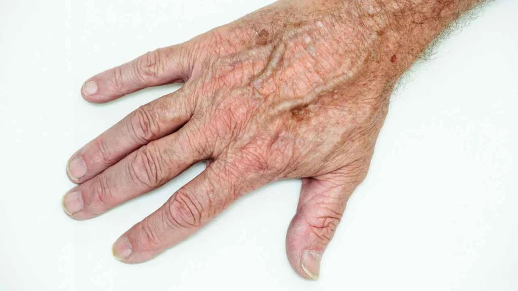 Male hand showing age spot Port Glasgow
