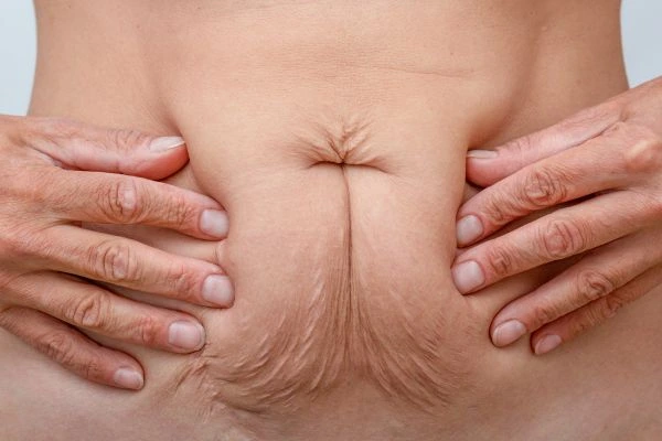 Should I Combine Diastasis Recti Treatment with Body Contouring for Better Results Port Glasgow?